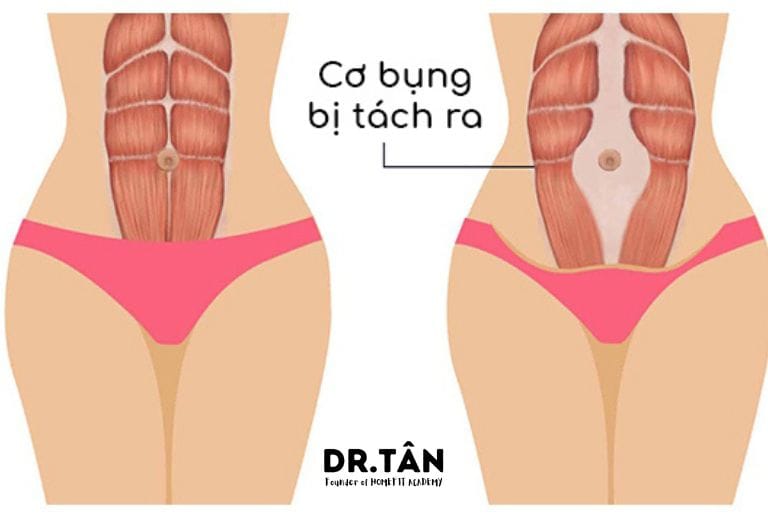 Xổ bụng sau sinh